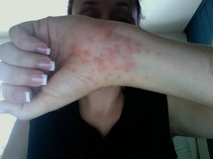 alergija-300x225