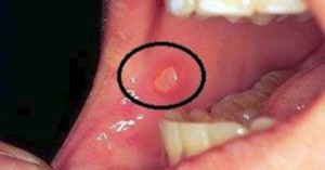 How to Cure Aphthae in Your Mouth by Yourself