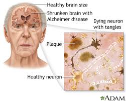 Alzheimer disease