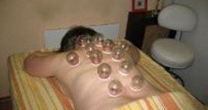 The Cupping Therapy 5000 years old – back pain, lower back pain, ischialgia